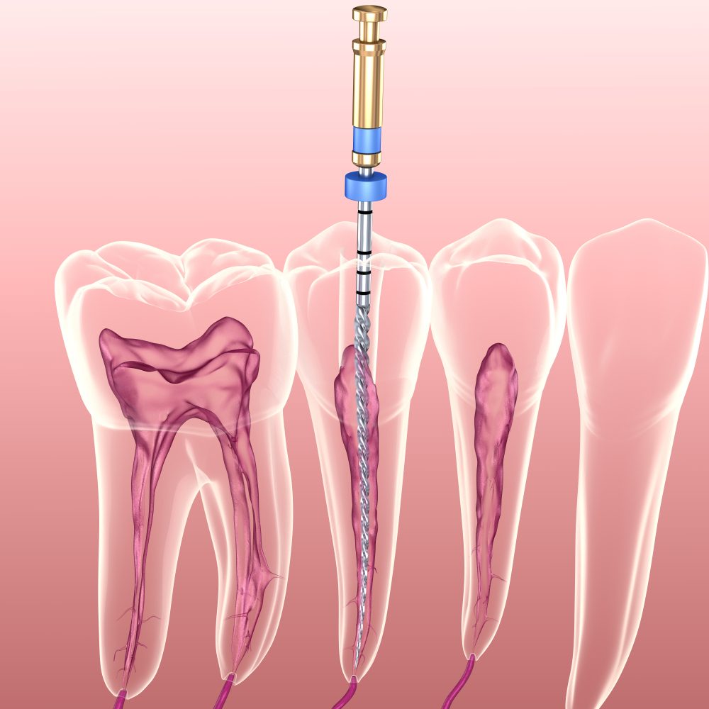 endodonties therapeies